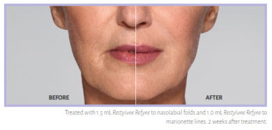 Restylane Refyne Before & After